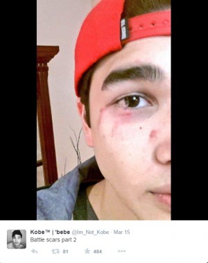 Kobe Paras shows his swollen eye. Screengrab from his Twitter account.